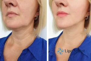 Double chin before and after Hi-Fu treatment 4 Book your double chin treatment Wiltshire today! We are here to help!