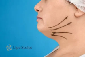 Double chin before and after Hi-Fu treatment 3 Boost your confidence with a Double chin treatment Wiltshire