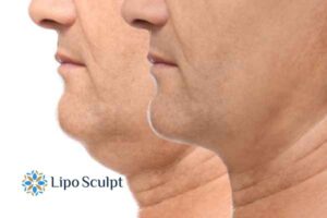 Double chin before and after Hi-Fu treatment 2 Double chin treatment Wiltshire from Lipo Sculpt - feel more confident today!