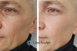 How to Fight Aging Symptoms 3 Fight Aging Symptoms Wiltshire With HIFU and Morpheus8 Today!
