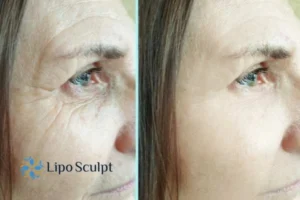 How to Fight Aging Symptoms 2 Do you want to Fight Aging Symptoms Wiltshire? Contact Lipo Sculpt today!