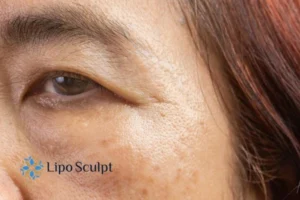 Cryopen: The Revolutionary Treatment for Age Spots Unveiled 2 Are age spots Wiltshire giving you low self esteem? Contact us today!