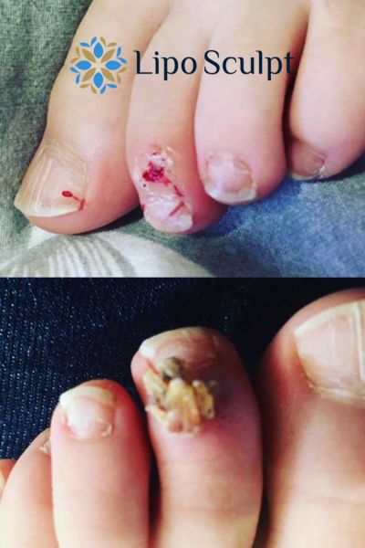 Wart removal customer results from Lipo Sculpt Wiltshire