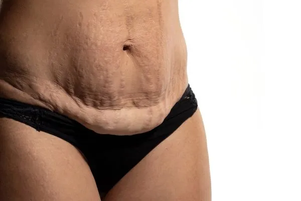 Lost the Weight but Not the Loose Skin? 1 image of womans stomach after weight loss showing loose skin Wiltshire