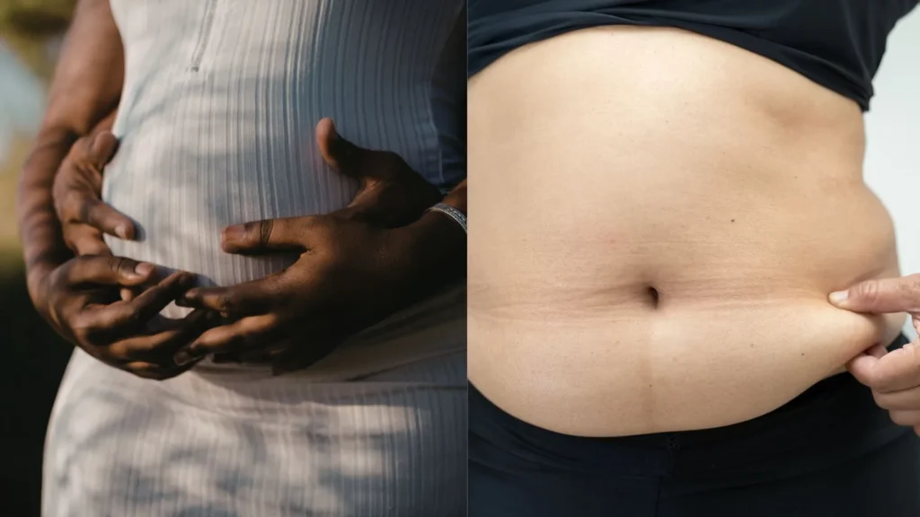Do Belly Bands Help Prevent Diastasis Recti? 4 When a Belly Band Genuinely Makes Sense in Case of Diastasis Recti